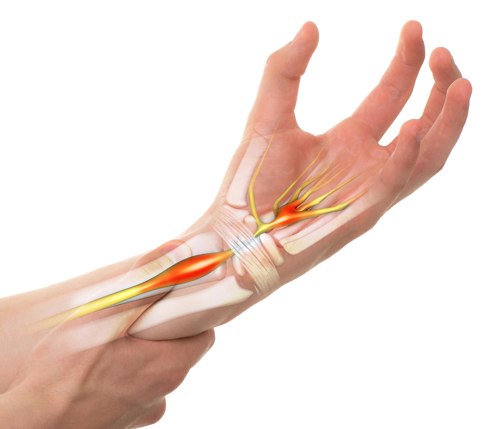How to Treat Carpal Tunnel Syndrome?