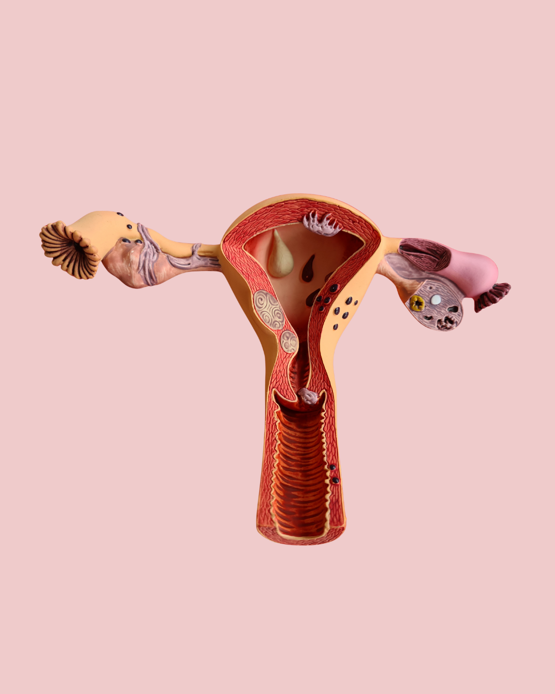 Endometriosis and Pelvic Floor Dysfunction: How Pain Impacts Muscles