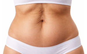 abdominal separation after pregnancy